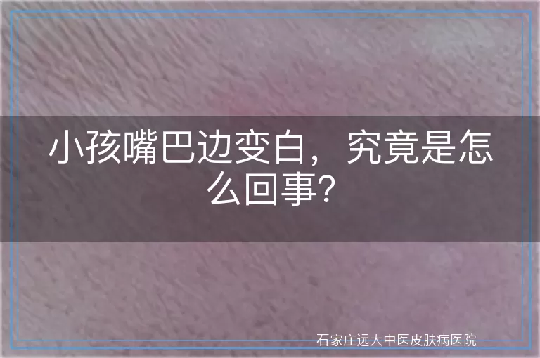 小孩嘴巴边变白，究竟是怎么回事？