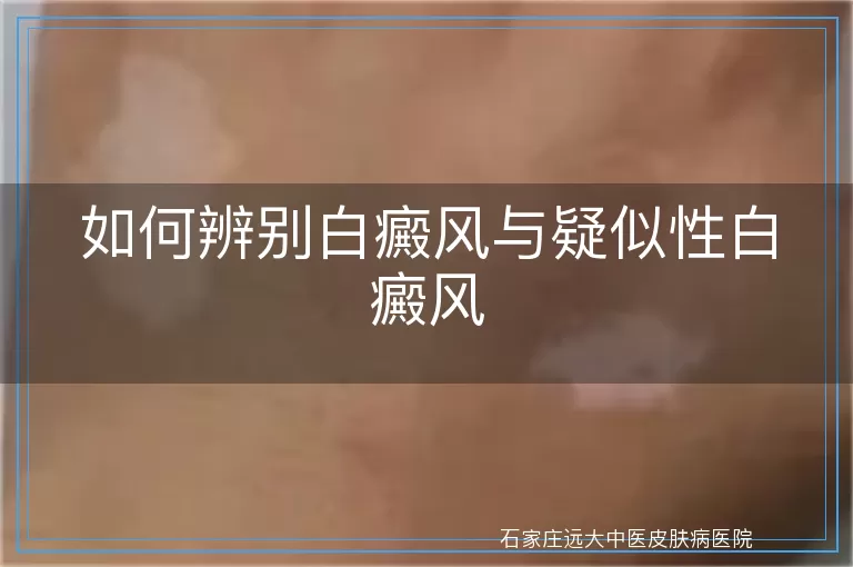 如何辨别白癜风与疑似性白癜风