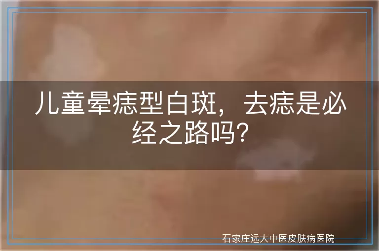 儿童晕痣型白斑，去痣是必经之路吗？