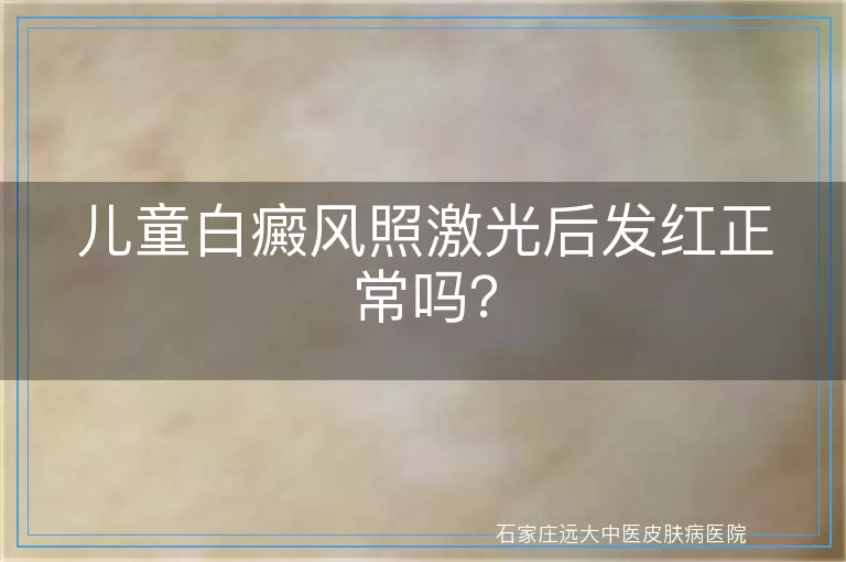 儿童白癜风照激光后发红正常吗？