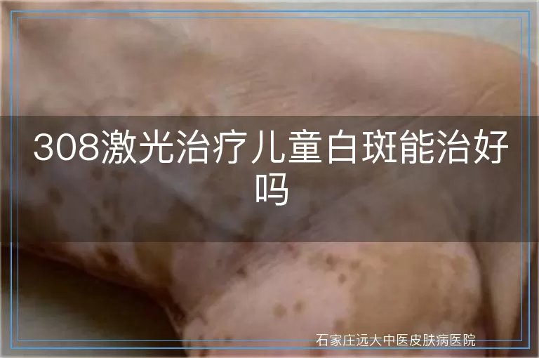 308激光治疗儿童白斑能治好吗