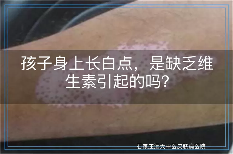 孩子身上长白点，是缺乏维生素引起的吗？