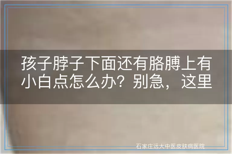 孩子脖子下面还有胳膊上有小白点怎么办？别急，这里有你想要的答案！