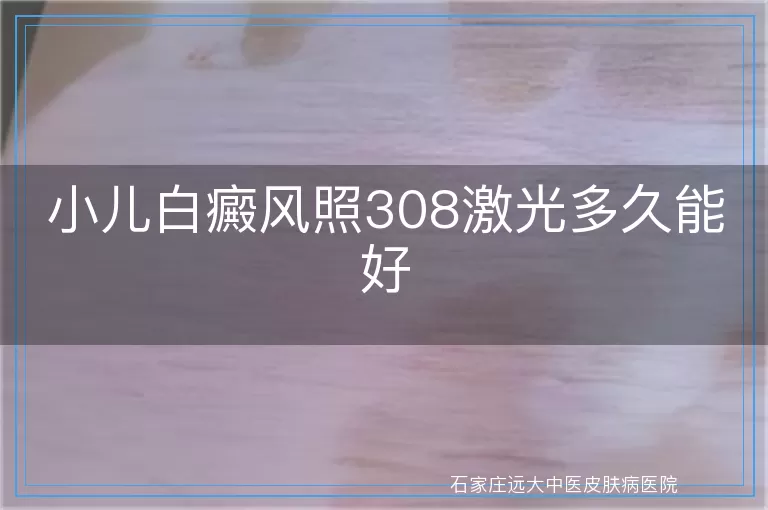 小儿白癜风照308激光多久能好