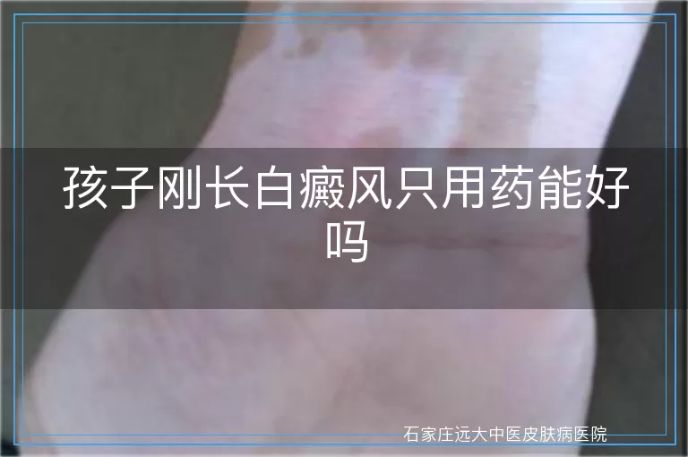 孩子刚长白癜风只用药能好吗