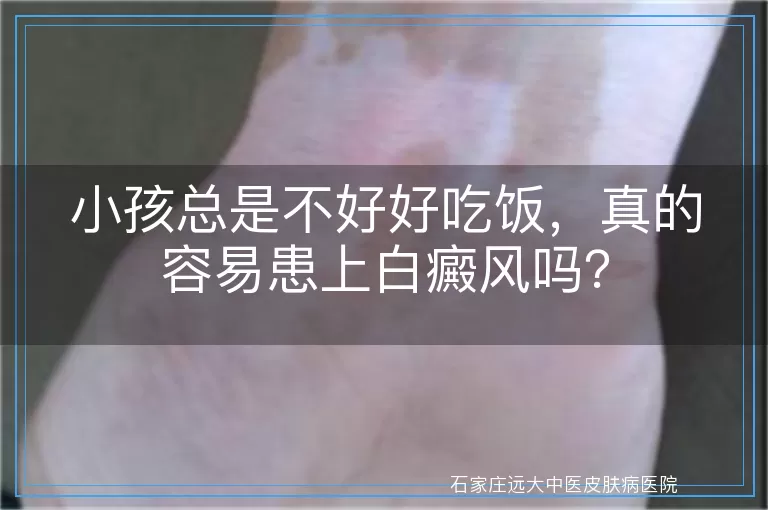 小孩总是不好好吃饭，真的容易患上白癜风吗？