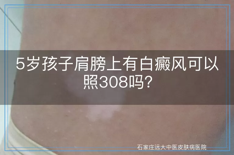 5岁孩子肩膀上有白癜风可以照308吗？