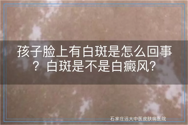 孩子脸上有白斑是怎么回事？白斑是不是白癜风？