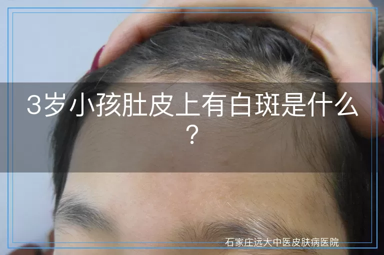 3岁小孩肚皮上有白斑是什么？