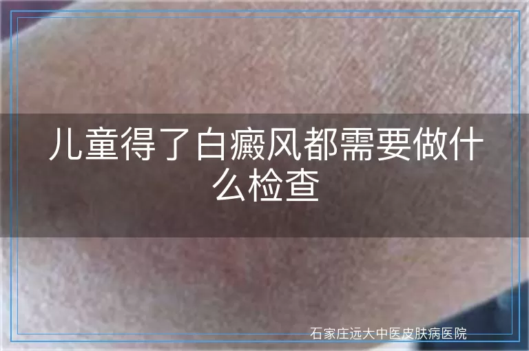 儿童得了白癜风都需要做什么检查