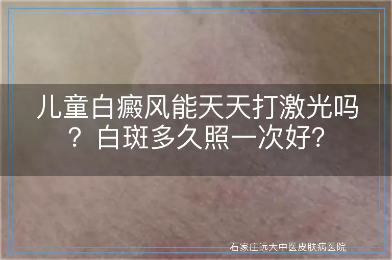 儿童白癜风能天天打激光吗？白斑多久照一次好？