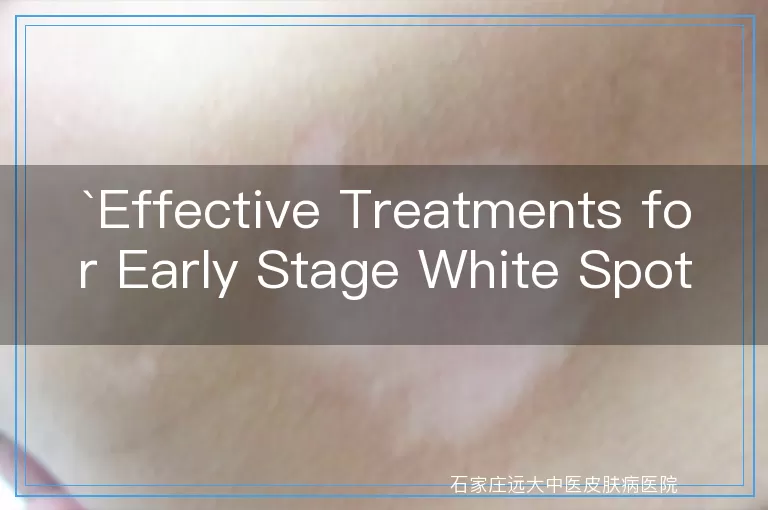 Effective Treatments for Early Stage White Spots in Infants