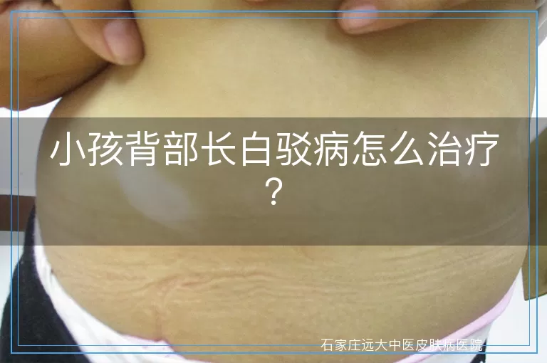 小孩背部长白驳病怎么治疗？