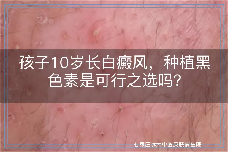 孩子10岁长白癜风，种植黑色素是可行之选吗？