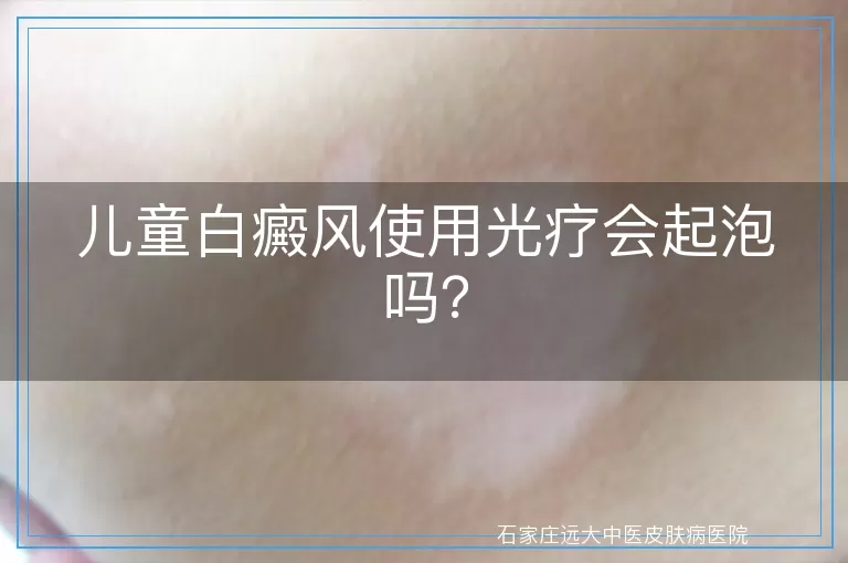 儿童白癜风使用光疗会起泡吗？