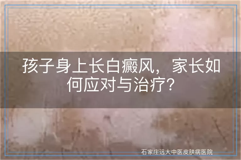 孩子身上长白癜风，家长如何应对与治疗？