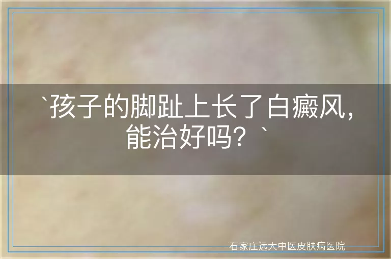 孩子的脚趾上长了白癜风，能治好吗？