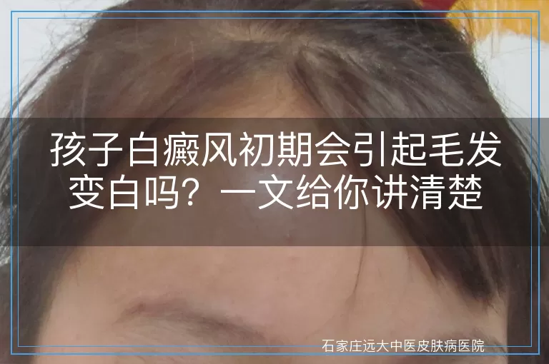 孩子白癜风初期会引起毛发变白吗？一文给你讲清楚