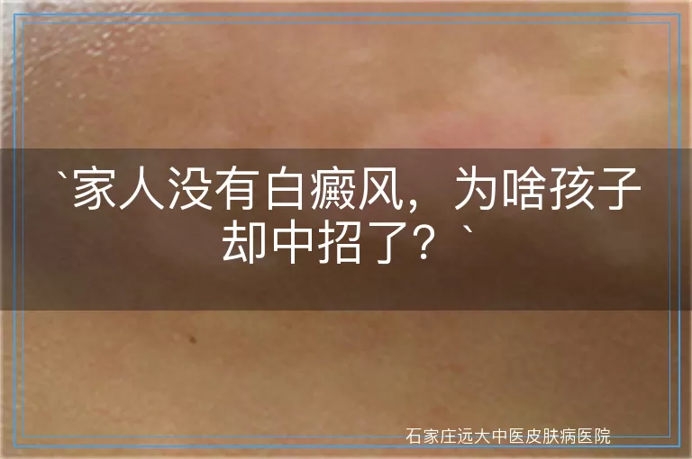 家人没有白癜风，为啥孩子却中招了？