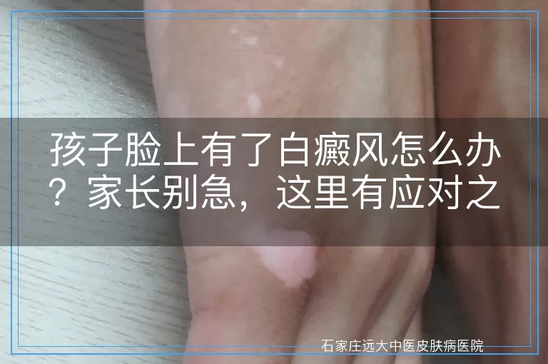 孩子脸上有了白癜风怎么办？家长别急，这里有应对之策！