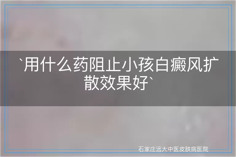 用什么药阻止小孩白癜风扩散效果好