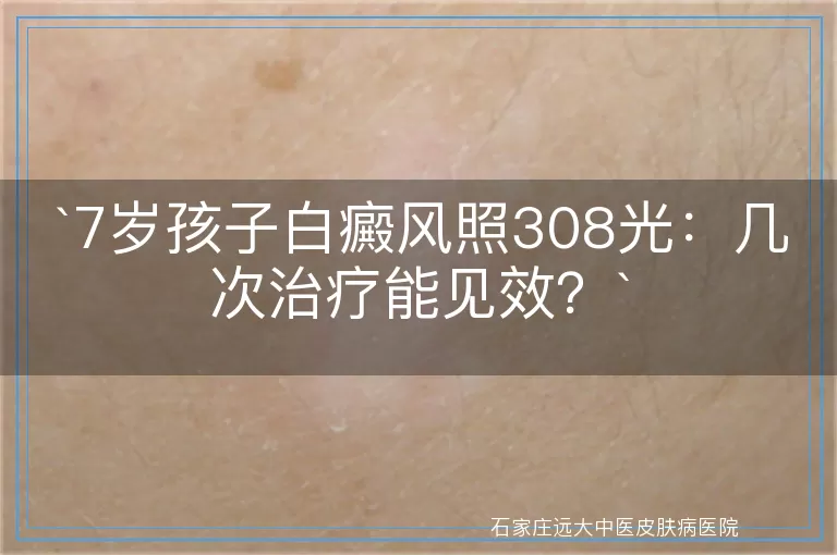 7岁孩子白癜风照308光：几次治疗能见效？