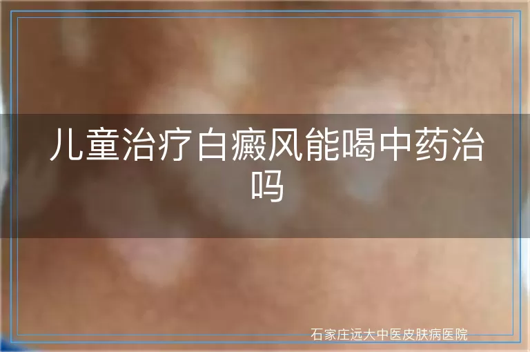 儿童治疗白癜风能喝中药治吗