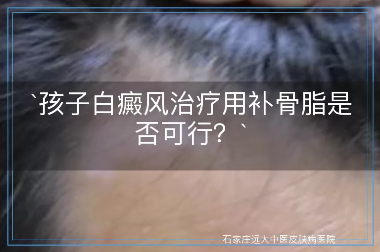 孩子白癜风治疗用补骨脂是否可行？