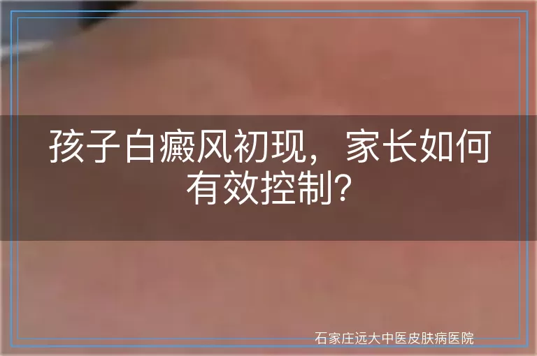 孩子白癜风初现，家长如何有效控制？