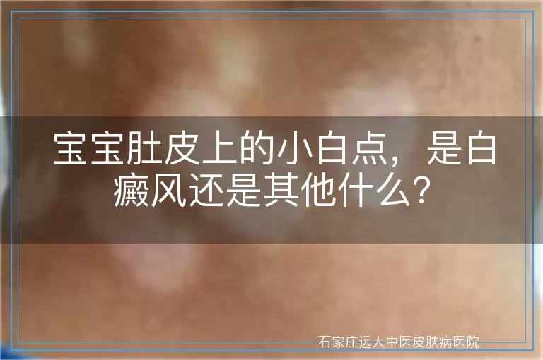 宝宝肚皮上的小白点，是白癜风还是其他什么？