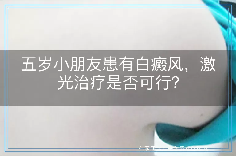 五岁小朋友患有白癜风，激光治疗是否可行？