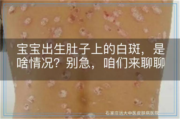 宝宝出生肚子上的白斑，是啥情况？别急，咱们来聊聊