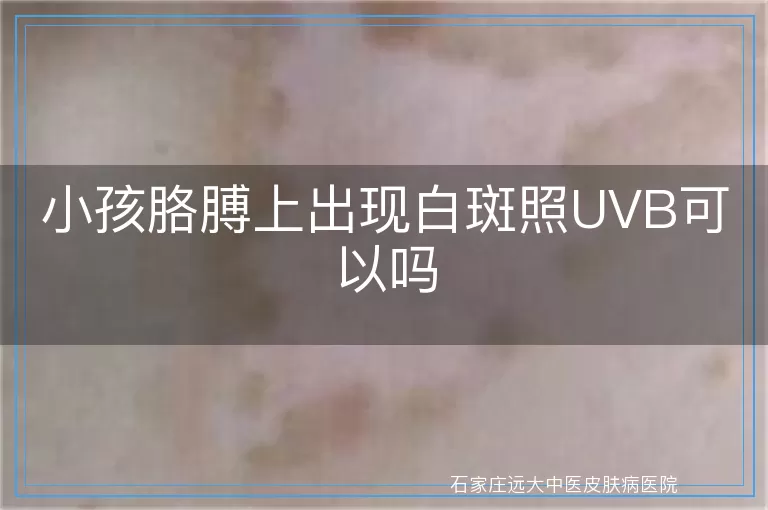 小孩胳膊上出现白斑照UVB可以吗