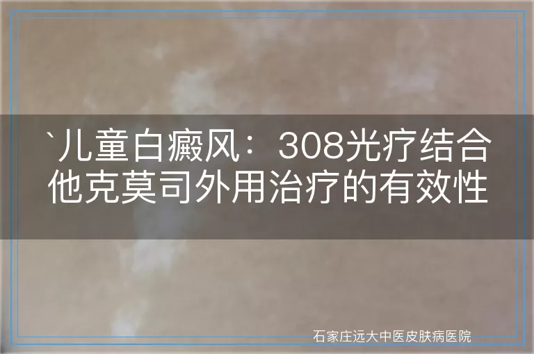 儿童白癜风：308光疗结合他克莫司外用治疗的有效性探讨