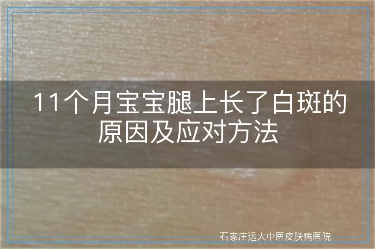 11个月宝宝腿上长了白斑的原因及应对方法