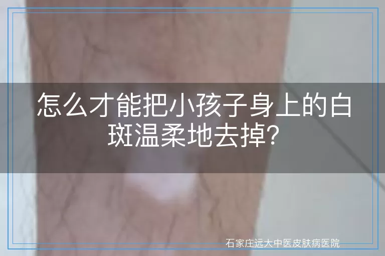 怎么才能把小孩子身上的白斑温柔地去掉？