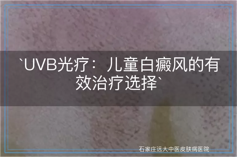 UVB光疗：儿童白癜风的有效治疗选择