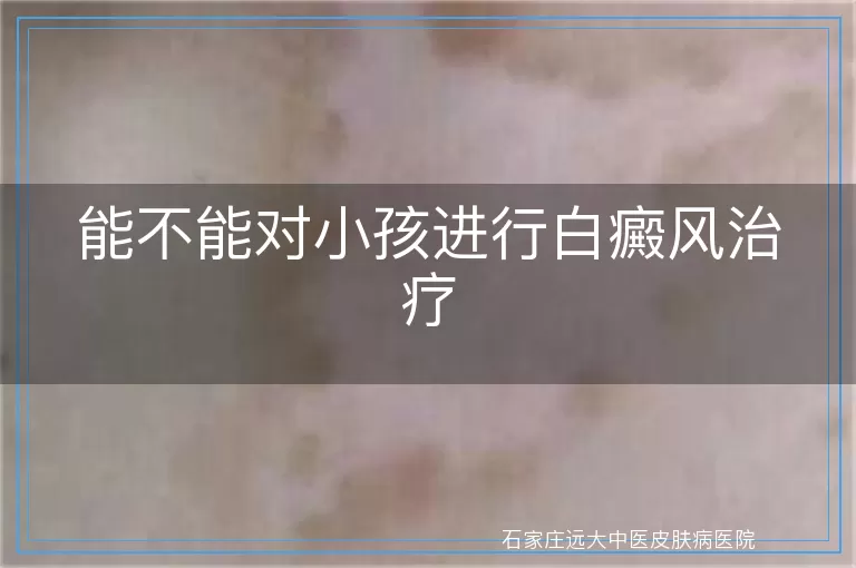 能不能对小孩进行白癜风治疗