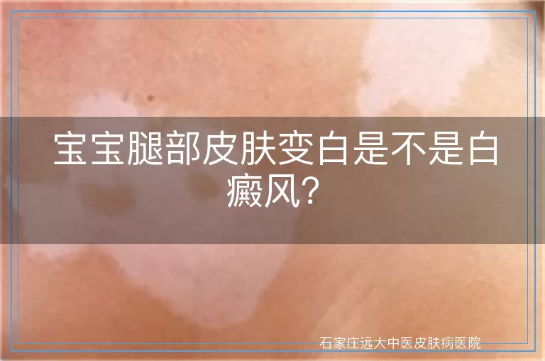 宝宝腿部皮肤变白是不是白癜风？