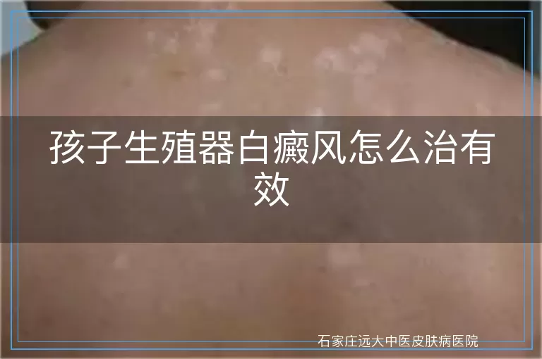 孩子生殖器白癜风怎么治有效