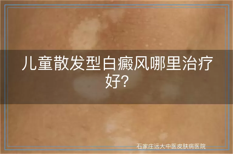 儿童散发型白癜风哪里治疗好？