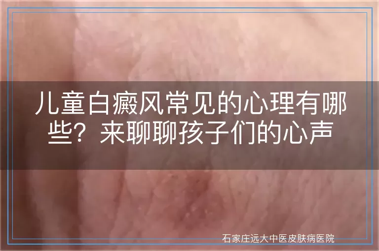 儿童白癜风常见的心理有哪些？来聊聊孩子们的心声