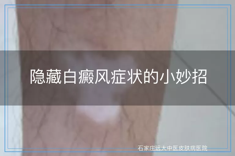 隐藏白癜风症状的小妙招