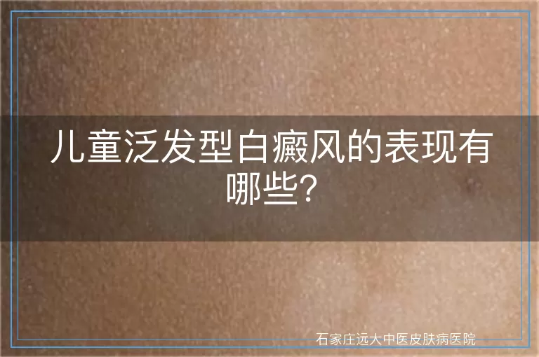 儿童泛发型白癜风的表现有哪些？