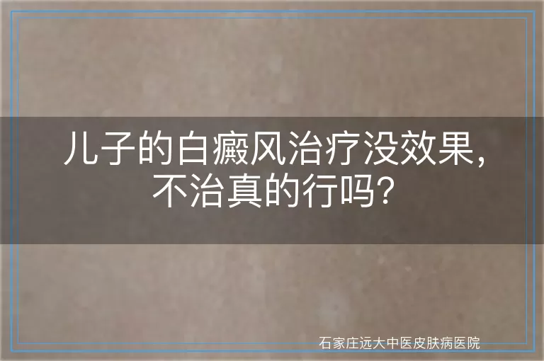 儿子的白癜风治疗没效果，不治真的行吗？