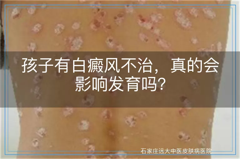 孩子有白癜风不治，真的会影响发育吗？