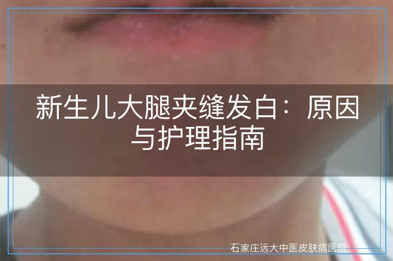 新生儿大腿夹缝发白：原因与护理指南