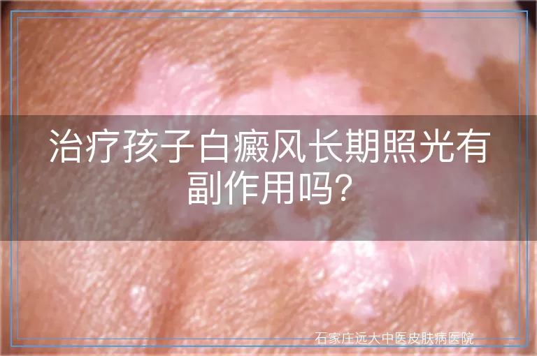 治疗孩子白癜风长期照光有副作用吗？