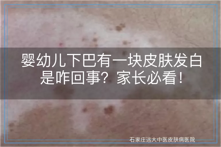 婴幼儿下巴有一块皮肤发白是咋回事？家长必看！