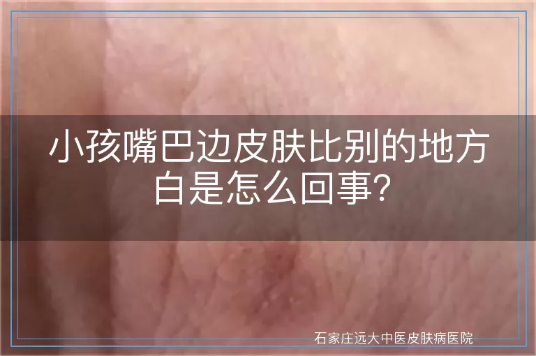 小孩嘴巴边皮肤比别的地方白是怎么回事？